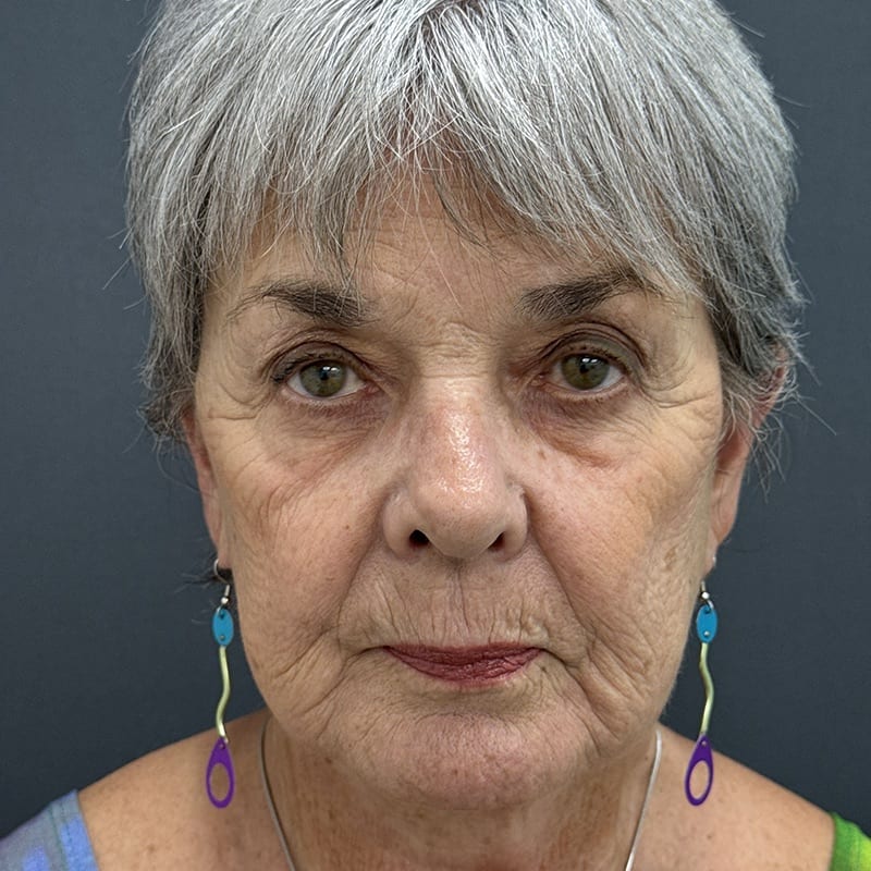 Facelift Before & After Image