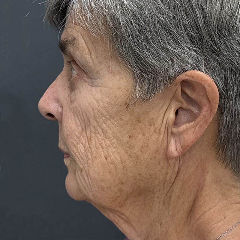 Facelift Before & After Image
