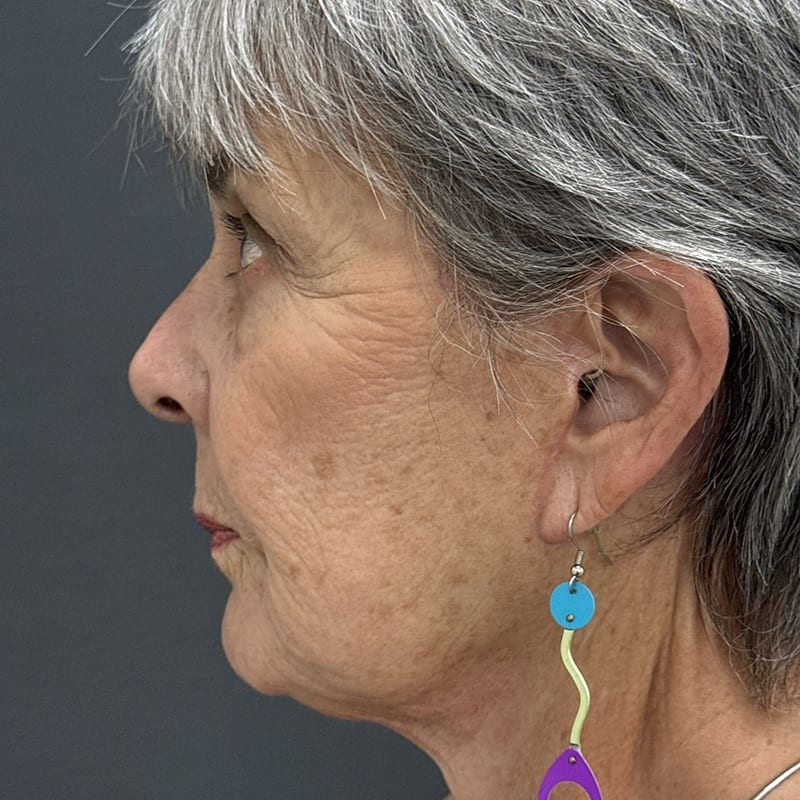 Facelift Before & After Image