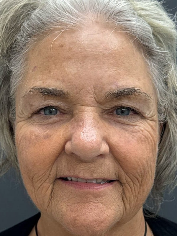 Laser Resurfacing Before & After Image