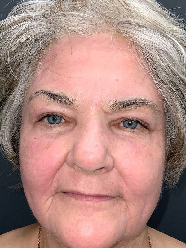 Laser Resurfacing Before & After Image