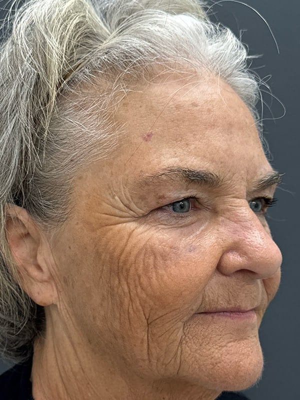 Laser Resurfacing Before & After Image