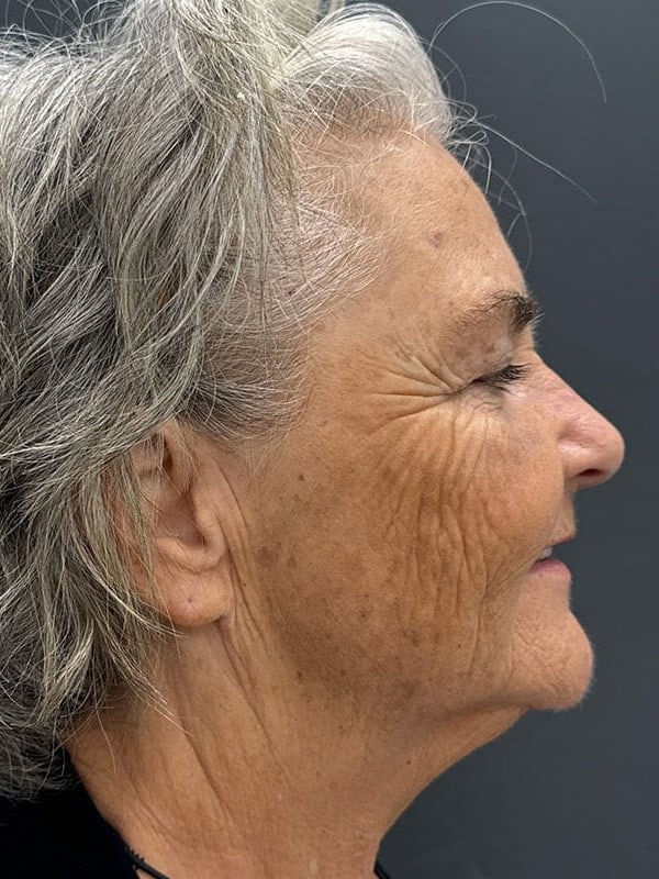 Laser Resurfacing Before & After Image