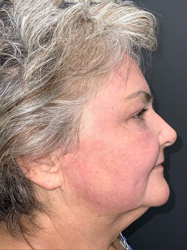Laser Resurfacing Before & After Image