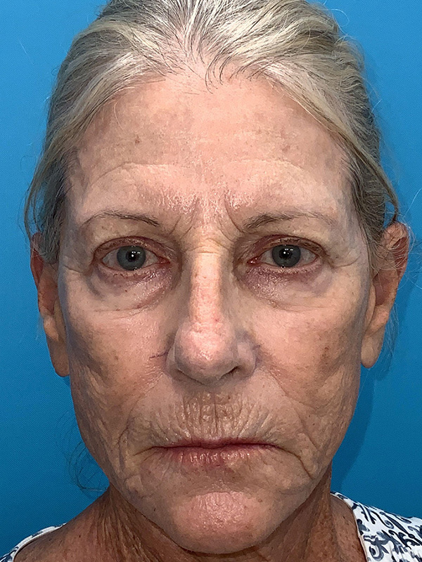 Laser Resurfacing Before & After Image