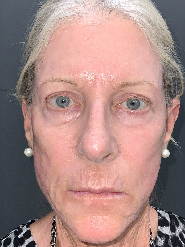 Laser Resurfacing Before & After Image