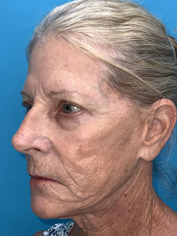 Laser Resurfacing Before & After Image