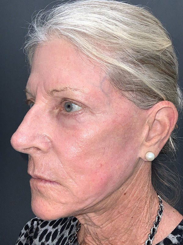 Laser Resurfacing Before & After Image