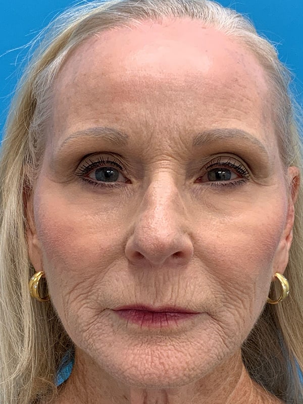 Laser Resurfacing Before & After Image