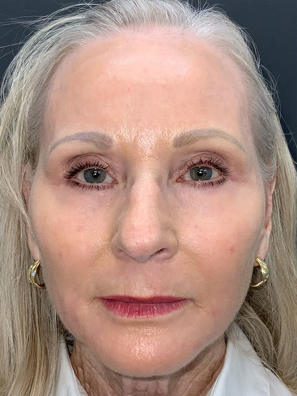 Laser Resurfacing Before & After Image