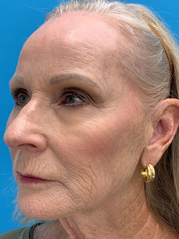 Laser Resurfacing Before & After Image