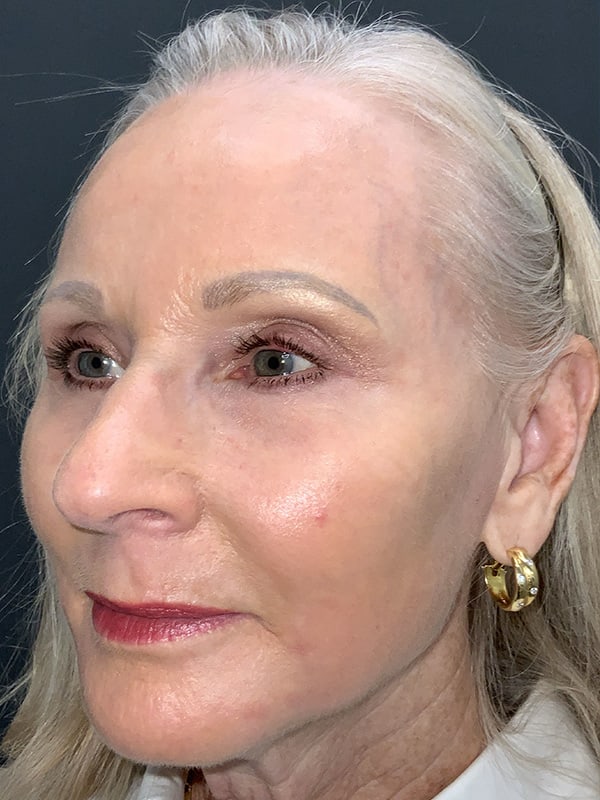 Laser Resurfacing Before & After Image