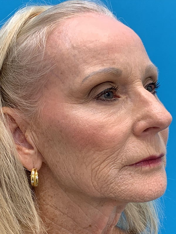 Laser Resurfacing Before & After Image