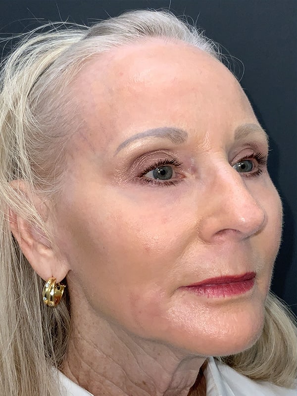 Laser Resurfacing Before & After Image