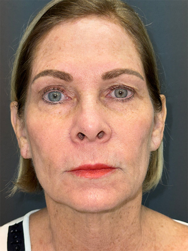 Laser Skin Resurfacing Before & After Image