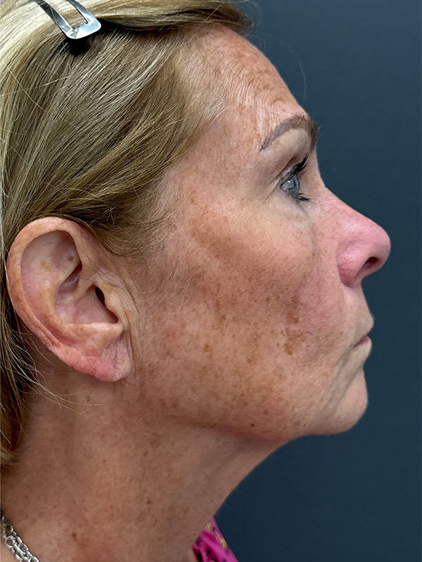 Laser Skin Resurfacing Before & After Image