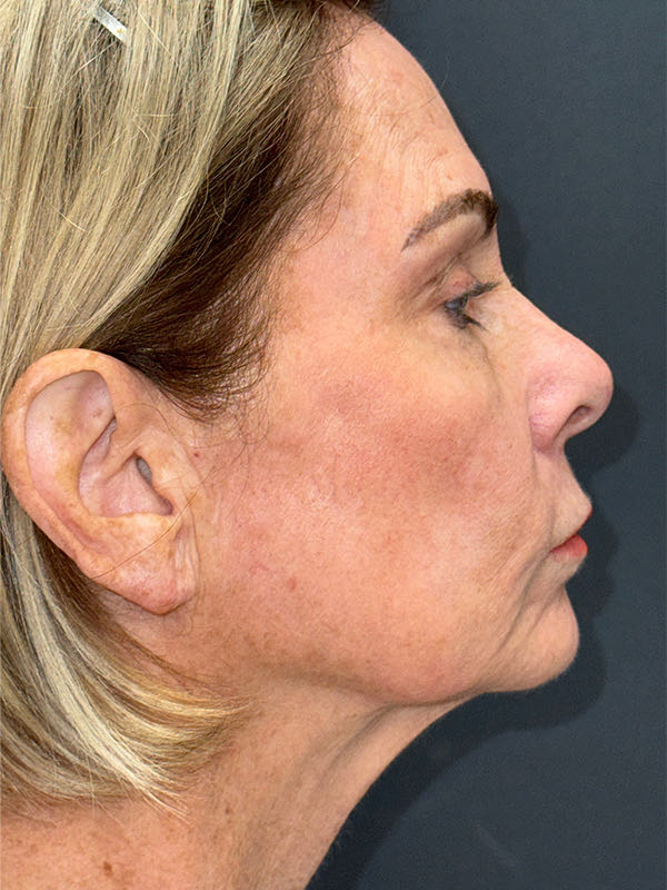 Laser Skin Resurfacing Before & After Image