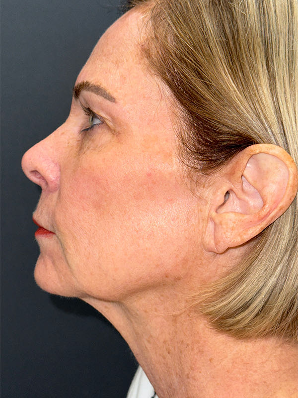 Laser Skin Resurfacing Before & After Image